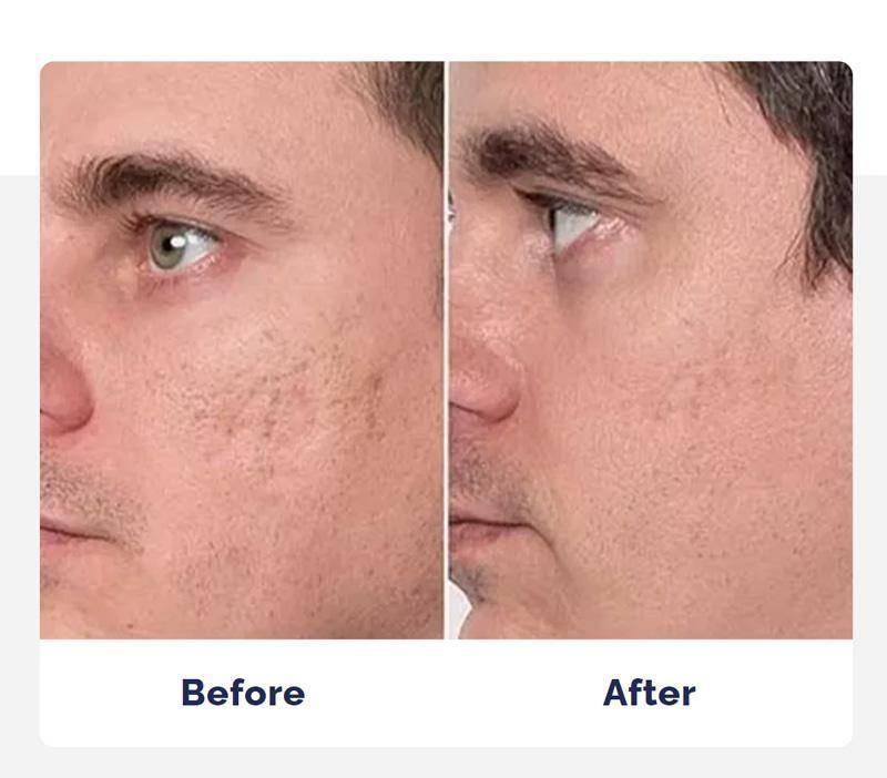scar gel before and after